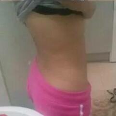 北京炫美腹部吸脂术后 腰腹部吸脂后一周照片