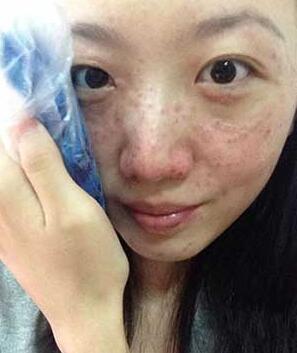 长春中研激光祛斑 让我告别了麻子脸