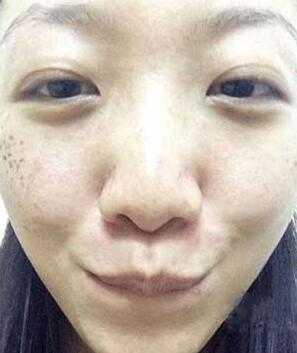 长春中研激光祛斑 让我告别了麻子脸