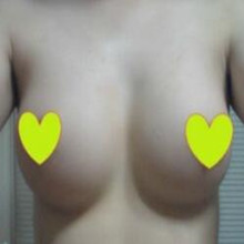 假体隆胸让我告别小平胸 感谢北京彤美