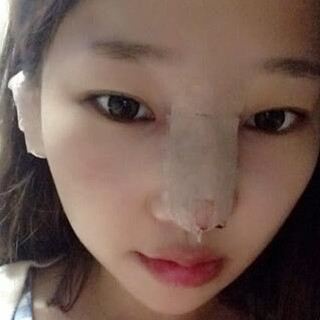 耳软骨隆鼻改变了我的塌鼻梁 北京彤美做的果很棒