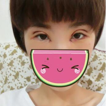 双眼皮修复成功辣  再也不用担心异样的眼光辣