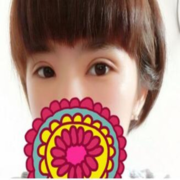 双眼皮修复成功辣  再也不用担心异样的眼光辣