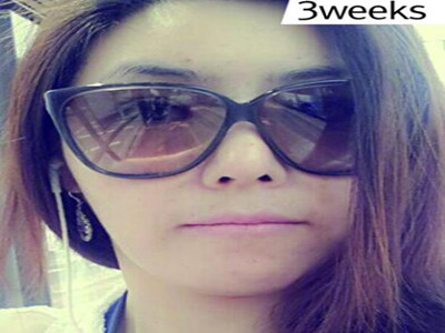 电波l皮除皱让我弹走小皱纹 果真的很不错