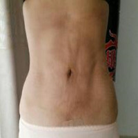 抽脂减肥瘦小腹 终于可以不用节食锻炼了