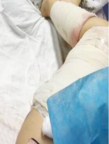 水动力吸脂瘦大腿让我告别小粗腿 快来看看果