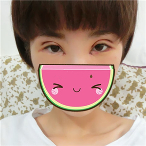 做park法双眼皮手术一个月了，果很好，有恢复过程照片哦~~