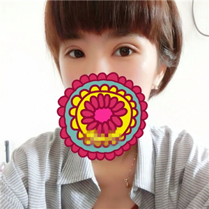 做park法双眼皮手术一个月了，果很好，有恢复过程照片哦~~