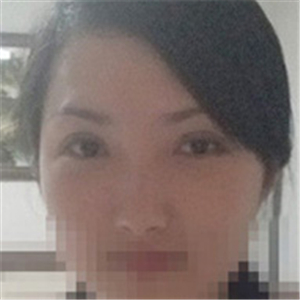 杨亚益医生做的双眼皮+开眼角，果不错，看看我的恢复照片~~~