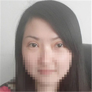 杨亚益医生做的双眼皮+开眼角，果不错，看看我的恢复照片~~~