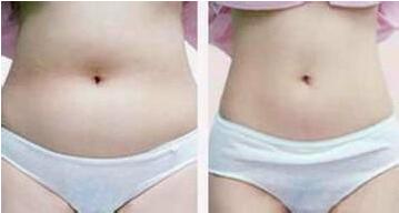 吸脂减肥瘦腰腹前后对比图片