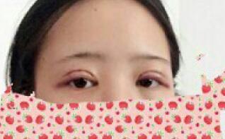 全切双眼皮和开内眼角两项整形,费用3880元