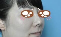 假体隆鼻术后差不多两个月了