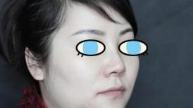 假体隆鼻术后45°角照片