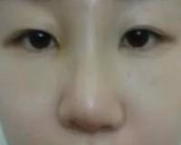 同学做了隆鼻，我也去做了个假体隆鼻，脸型真心立体了好多