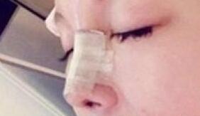 假体隆鼻的照片,假体隆鼻过程介绍