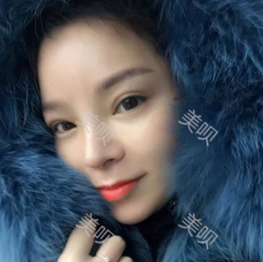 我做的自体脂肪隆鼻果杠杠的我很满意~~~