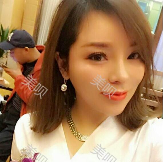 我做的自体脂肪隆鼻果杠杠的我很满意~~~
