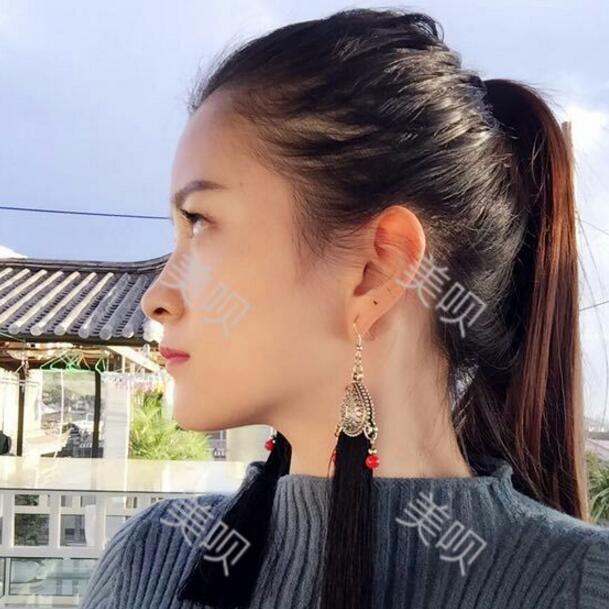 我做了玻尿酸隆鼻后被同学叫网红哈哈~~~