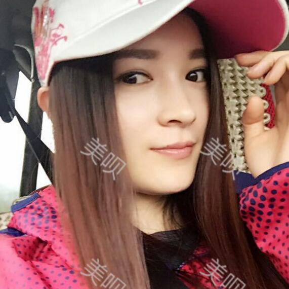 我做了玻尿酸隆鼻后被同学叫网红哈哈~~~