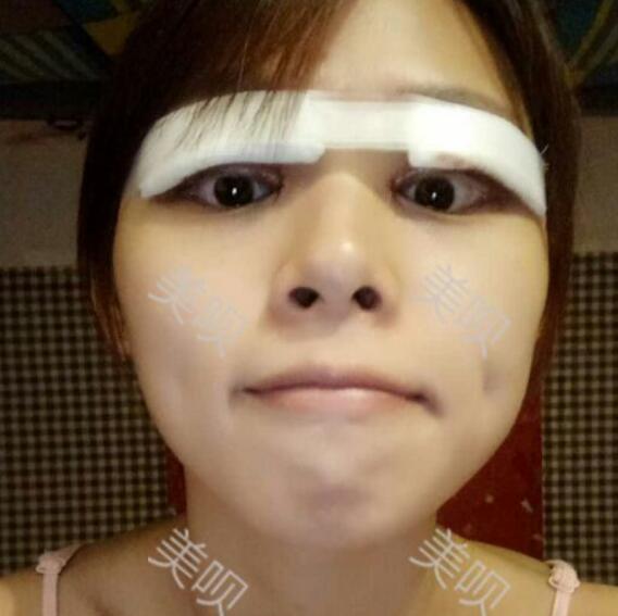 在东莞华美做的切开双眼皮感觉果棒棒哒