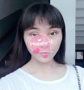 南京康美张让虎医生给我做的眼部综合整形，大家来看看怎么样