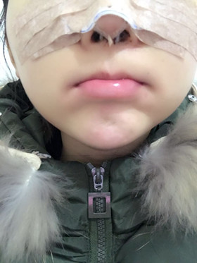 去年做的隆鼻整形手术，恢复的差不多了