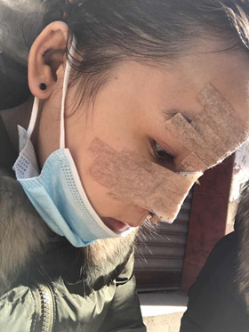 去年做的隆鼻整形手术，恢复的差不多了