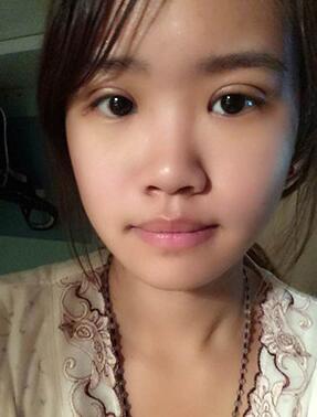 纳米x雕双眼皮15天了~ 我恢复的算快吗