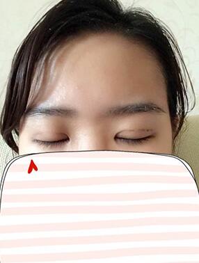 纳米x雕双眼皮15天了~ 我恢复的算快吗