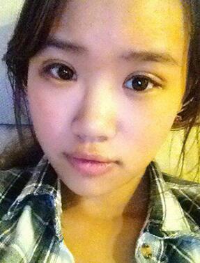 纳米x雕双眼皮15天了~ 我恢复的算快吗