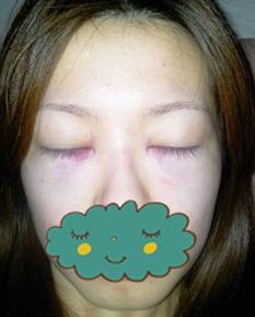 杭州时光激光去眼袋1个月了