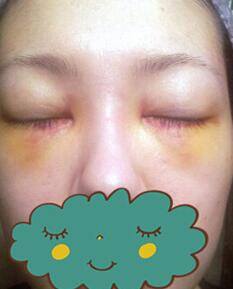 杭州时光激光去眼袋1个月了