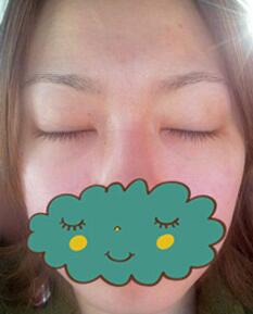 杭州时光激光去眼袋1个月了