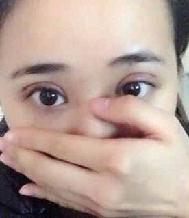 北京常好丽格割双眼皮一周啦~