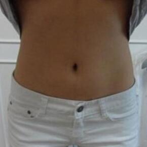 北京常好丽格腰腹吸脂后20天的感受 恢复日记来咯~