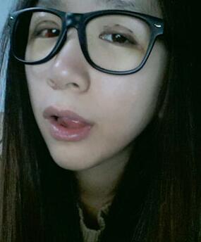 北京常好丽格三点定位双眼皮恢复一个月经历