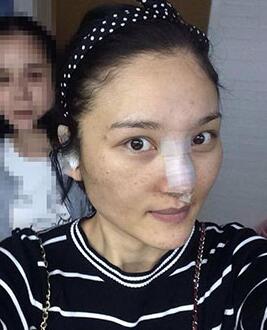 北京常好丽格做假体隆鼻3个月
