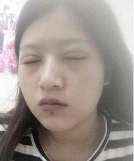 广州丽尚做的全切开双眼 变身混血儿