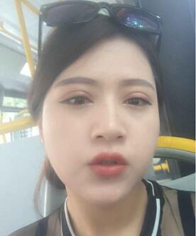 广州丽尚做的全切开双眼 变身混血儿