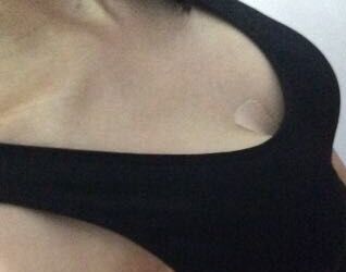 合肥华美赵辑做的曼托假体隆胸后我从A变成C罩杯