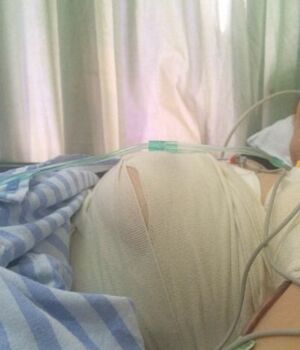 曼托毛面假体隆胸后我也是大胸妹子啦