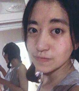 激光点痣不留坑不留疤，果棒棒哒