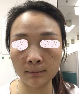 激光去黄褐斑后皮肤干净多了呢