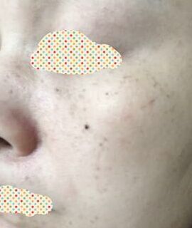 激光去黄褐斑后皮肤干净多了呢