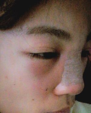 硅胶假体隆鼻后侧面看起来超**的