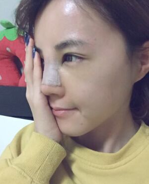 硅胶假体隆鼻后侧面看起来超**的