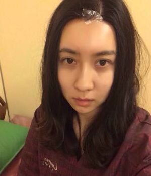 自体脂肪全脸填充后整个面部都很饱满哟