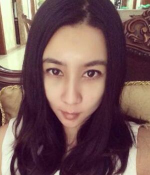 自体脂肪全脸填充后整个面部都很饱满哟