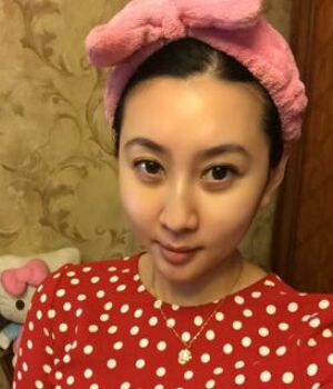 自体脂肪全脸填充后整个面部都很饱满哟